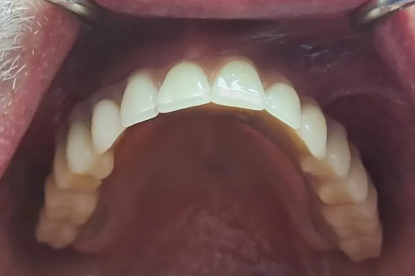 Rezultat posle All on 6 procedure