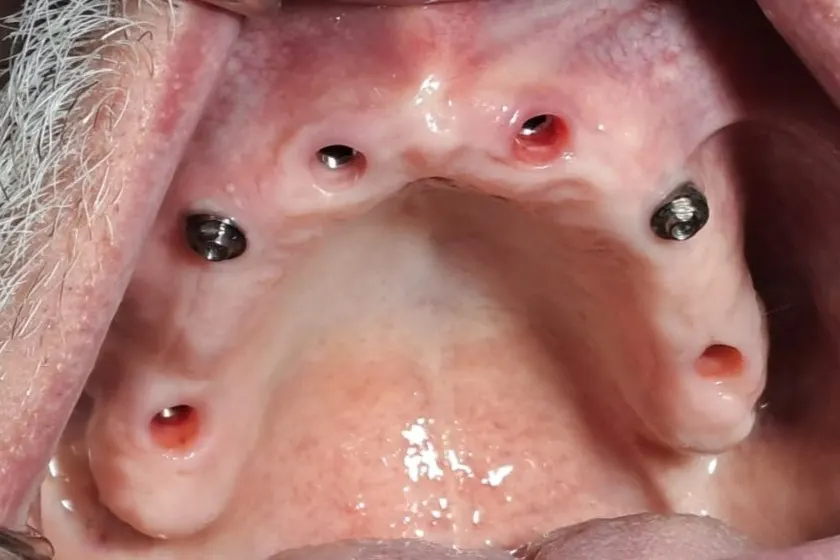 Stanje pre All on 6 procedure