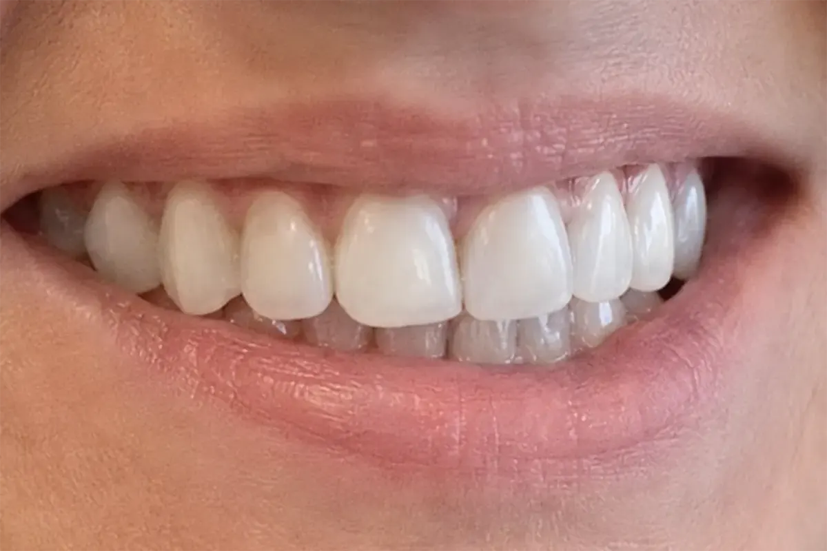 Rezultat posle All on 4 procedure