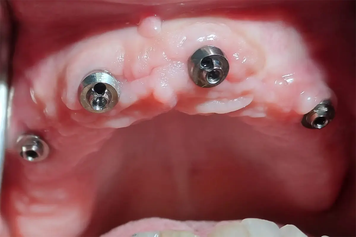 Stanje pre All on 4 procedure